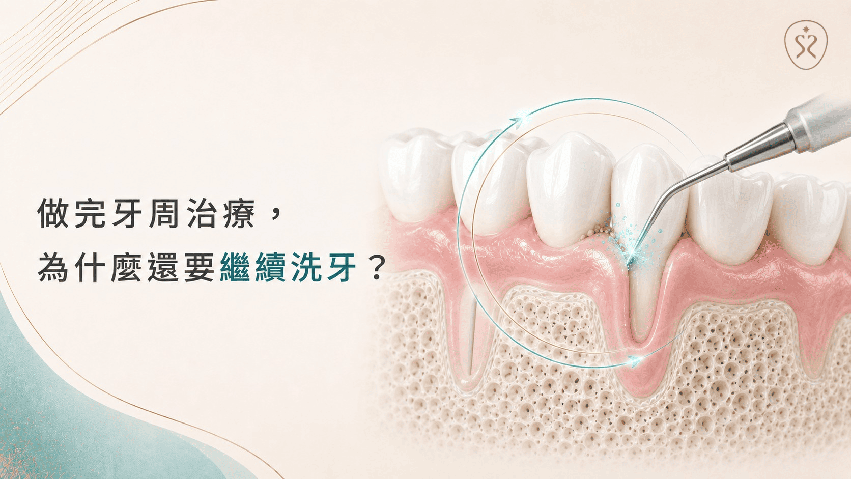 做完牙周治療為什麼還要繼續洗牙